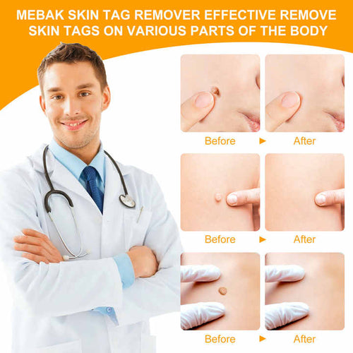 2 In1 Painless Auto Skin Tag Mole Removal Kit